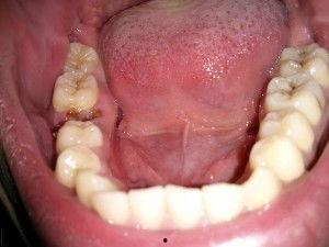 成人龋齿实拍视频大全,实拍视频大全深度解析  第1张