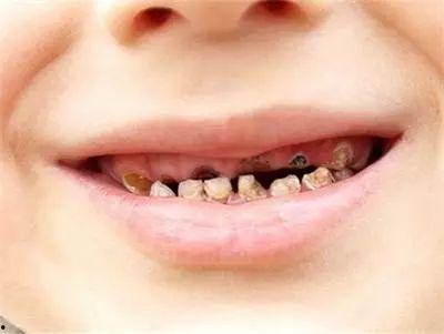 成人龋齿实拍视频大全,实拍视频大全深度解析  第3张